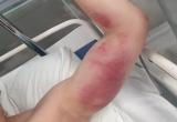 В Калуге 20-летний парень попал в больницу после укуса гадюки