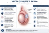 Симптомы и причины появления кисты придатка яичка